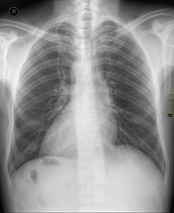 Chest X-Ray - dextrocardia