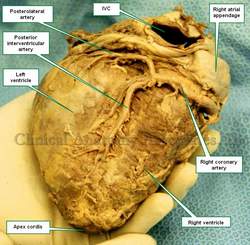 Posteroinferior view of the heart. IVC=inferior Vena Cava