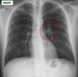 AP thoracic x-ray image showing the location of the pulmonary hilum. Image courtesy of Prof. Uribe