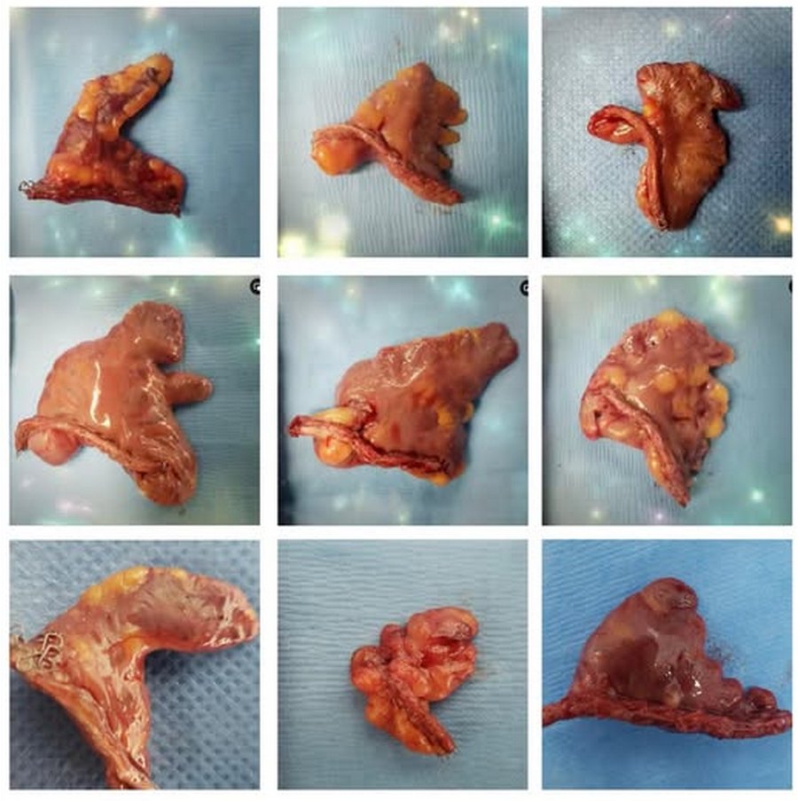 Left atrial appendage shapes. Courtesy of Sandra Fezzat Schrameyer Left atrial appendage shapes. Courtesy of Sandra Fezzat Schrameyer