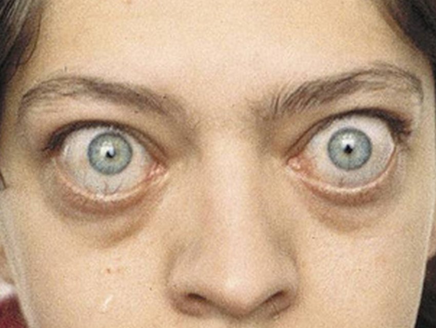 exophthalmos definition bulging eyeballs