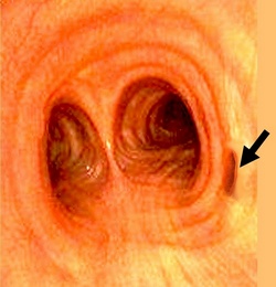 Tracheal bronchus (pig bronchus) Tracheal bronchus (pig bronchus)