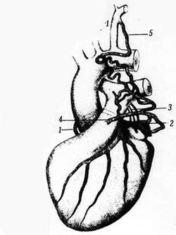 Coronary artery arising from the pulmonary trunk (Brooks, 1886)