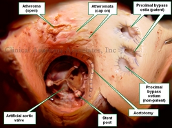 Superior view of the ascending aorta