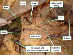 Anteroinferior view of the liver and stomach, the duodenum and stomach are reflected anteriorly. CT= Celiac trunk, CHA= Common hepatic artery, PHA= Proper hepatic artery, GDA= Gastroduodenal artery