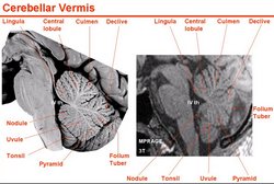 Median section of the cerebellar vermis