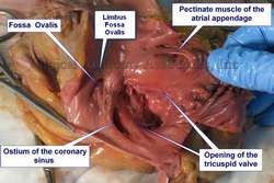 Human heart - open right atrium