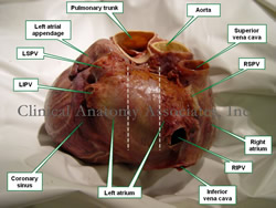 Human heart - Posterior view showing the cardiac base. P=posterior; S=superior;R=right;L=left; PV=pulmonary vein