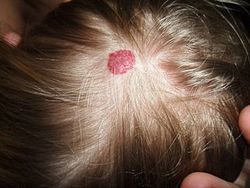 Small hemangioma on the scalp of a two year old female.  By Cbheumircanl (Own work) [Public domain], via Wikimedia Commons