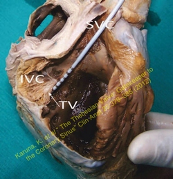 IVC, inferior vena cava; SVC, superior vena cava; TV, Thebesian valve