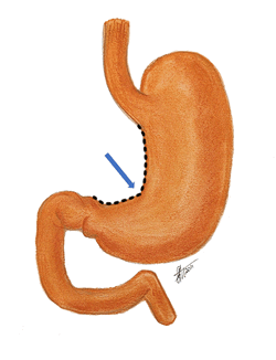 Anterior view of the stomach