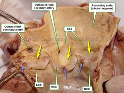 Aortic root of the ascending aorta open by dissection. The blue arrows show the nodes of Aranttius