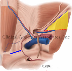 Triangle of pain. Posterior view of the inguinal region. The triangle of pain is depicted in yellow. The blue arrow indicates the corona mortis