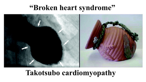 Takotsubo cardiomyopathy (Broken Heart Syndrome)